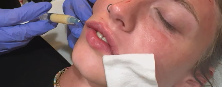 Why PRP & PRF Fillers Are Better Than Synthetic Fillers | Natural Results at Anagen