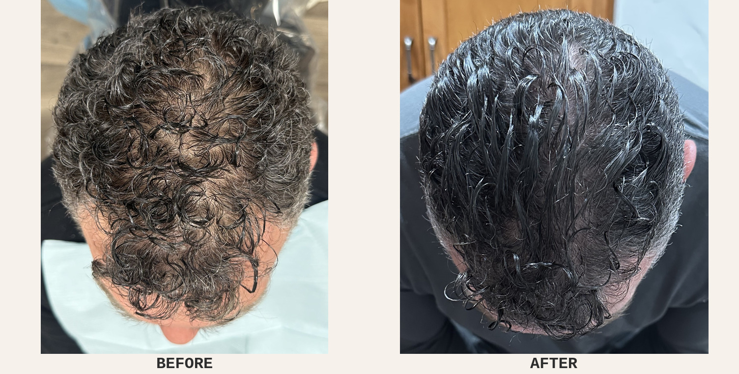 iPRF Hair Regeneration Edmond | iPRF vs PRP + Red Light
