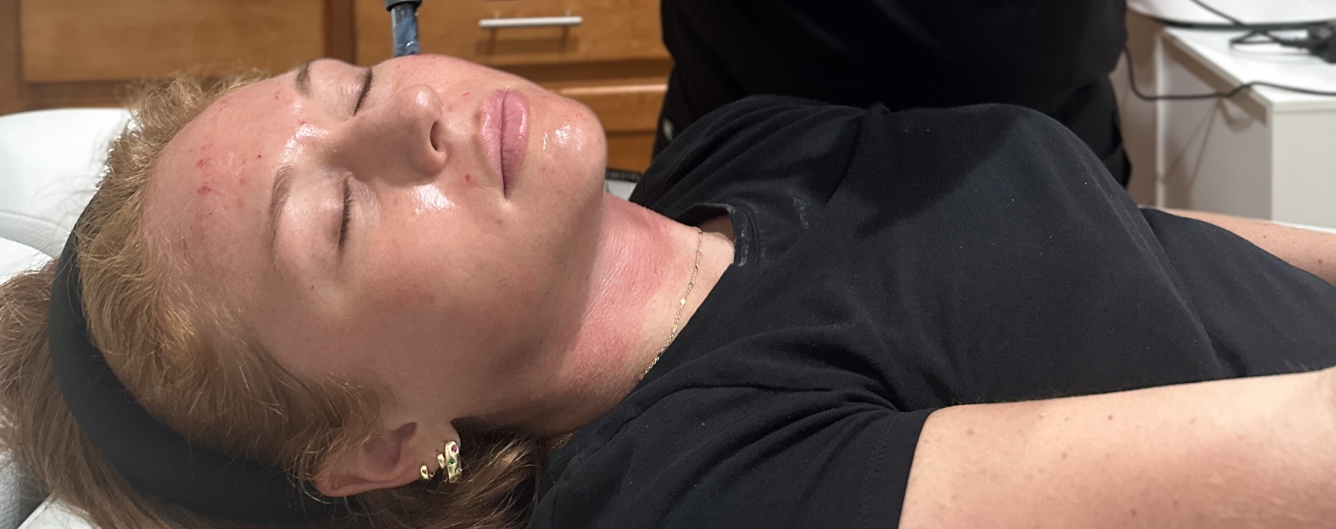 iPRF Facial vs Vampire Facial: Which Is Better?