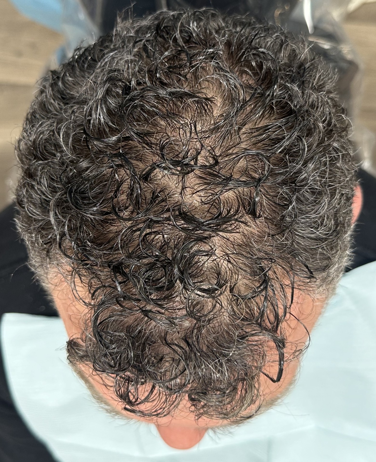 Before PRP and iPRF hair restoration treatment showing crown thinning