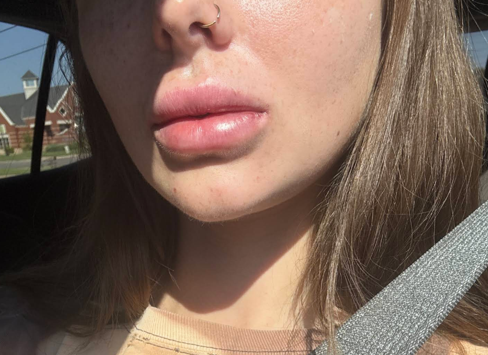 Natural-looking lip enhancement result after e-PRF/PRF lip filler with Dr. Peck at Anagen Medical Institute